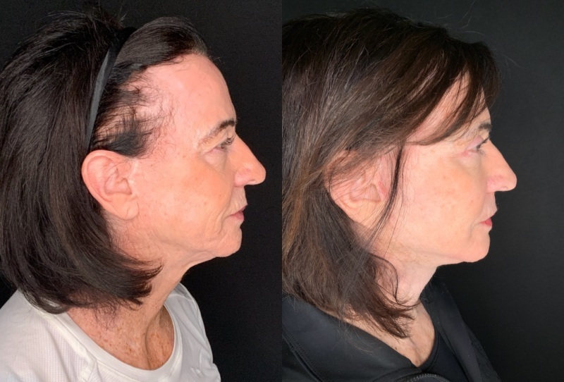 Patient #14569: Facelift with Neck Lift, Facial Fat Injections, Upper Bleharoplasty, Brow Lift, & CO2 Resurfacing Combine Image