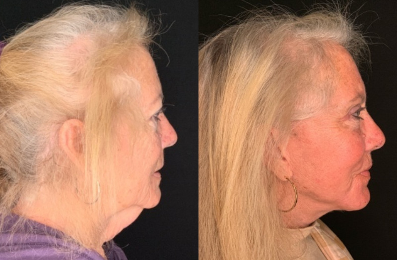 Patient #35246: Facelift with Lip Lift, Facial Fat Injections, CO2 Laser, and Upper Blepharoplasty Combine Image
