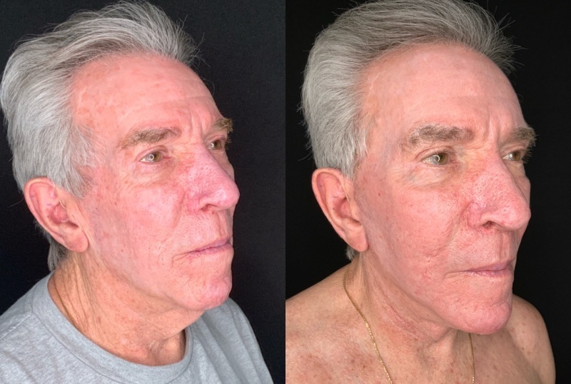 Patient #54698: Facelift with Chin Augmentation, Facial Implants and Fat Injections, and Resurfacing Combine Image