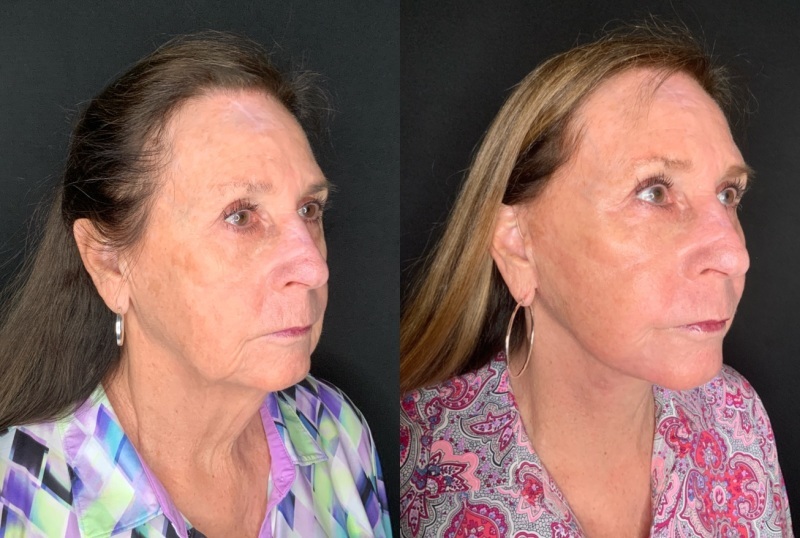 Patient #66996: Facelift with Laser Resurfacing and Facial Fat Injections Combine Image