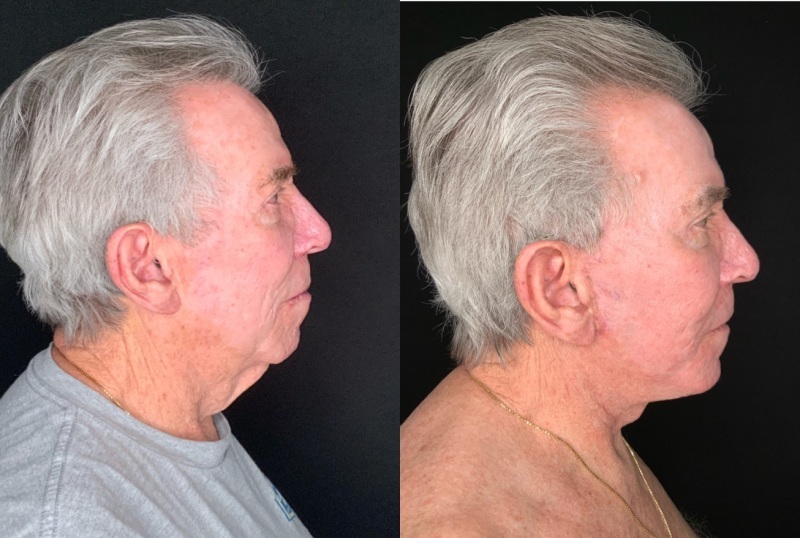 Patient #54698: Facelift with Chin Augmentation, Facial Implants and Fat Injections, and Resurfacing Combine Image
