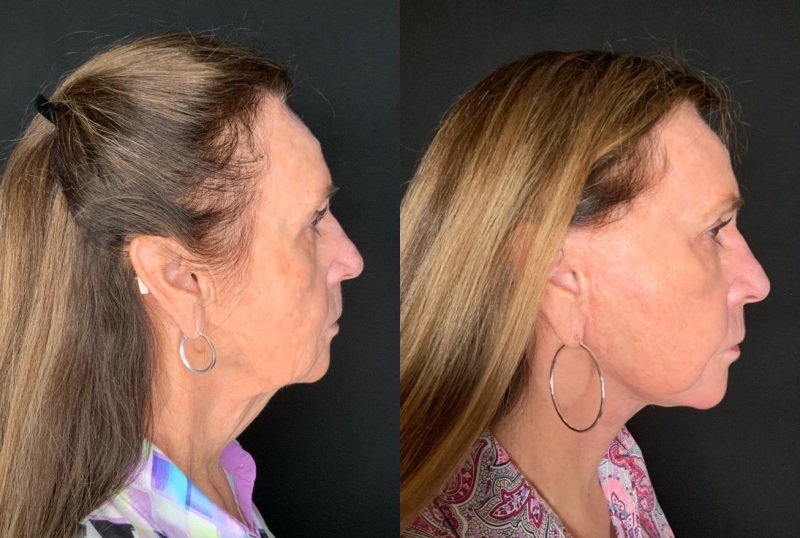 Patient #66996: Facelift with Laser Resurfacing and Facial Fat Injections Combine Image