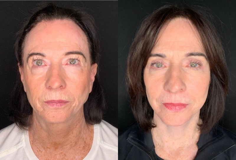 Patient #14569: Facelift with Neck Lift, Facial Fat Injections, Upper Bleharoplasty, Brow Lift, & CO2 Resurfacing Combine Image