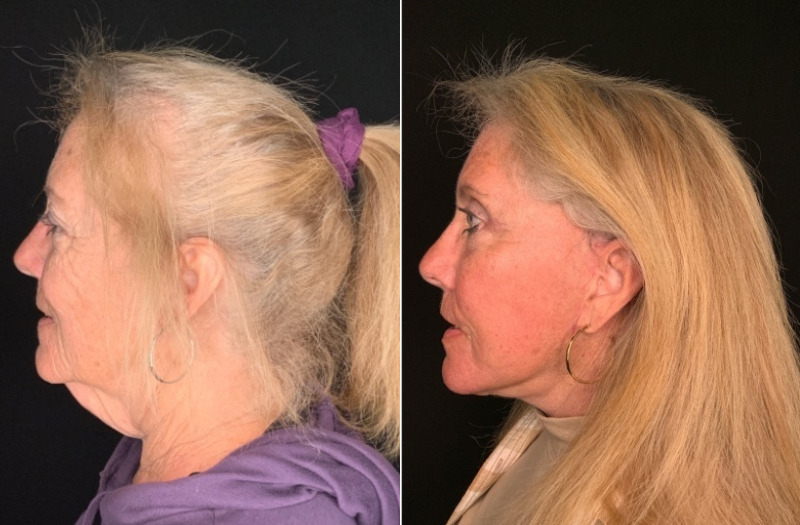 Patient #35246: Facelift with Lip Lift, Facial Fat Injections, CO2 Laser, and Upper Blepharoplasty Combine Image