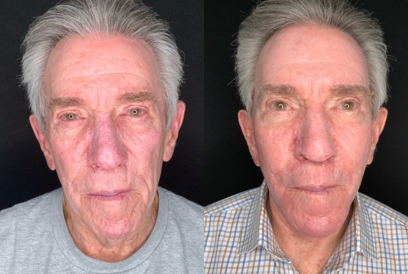 Patient #54698: Facelift with Chin Augmentation, Facial Implants and Fat Injections, and Resurfacing Combine Image