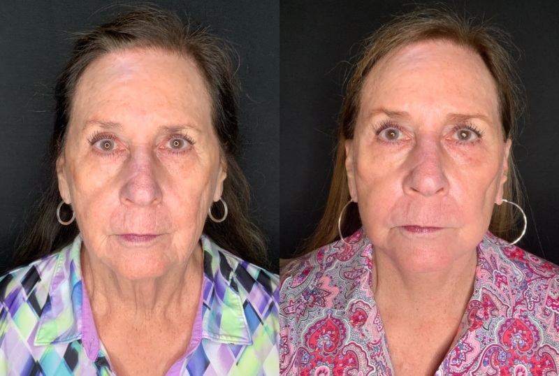 Patient #66996: Facelift with Laser Resurfacing and Facial Fat Injections Combine Image