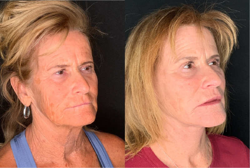 Patient #57974: Facelift with Platysmaplasty, Facial Fat Injections, Bilateral Upper Blepharoplasty, and Endoscopic Browlift Combine Image
