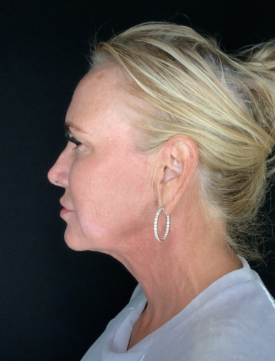 Patient #32148: FaceTite After Image