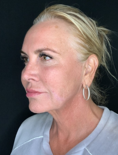 Patient #32148: FaceTite After Image