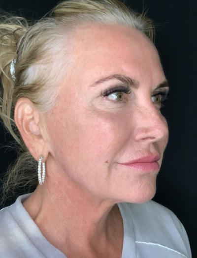 Patient #32148: FaceTite After Image