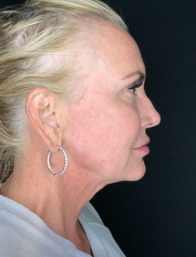 Patient #32148: FaceTite After Image