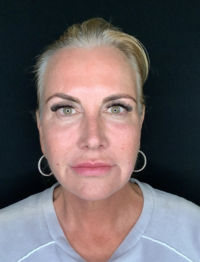 Patient #32148: FaceTite After Image