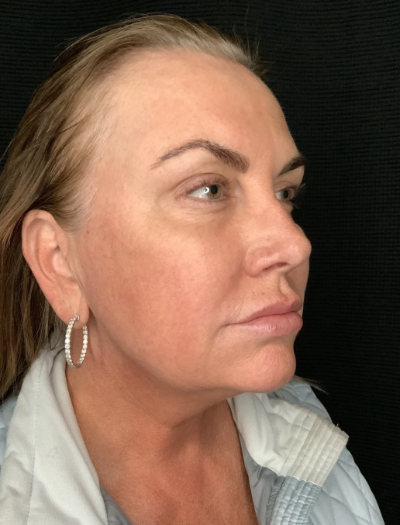 Patient #32148: FaceTite Before Image