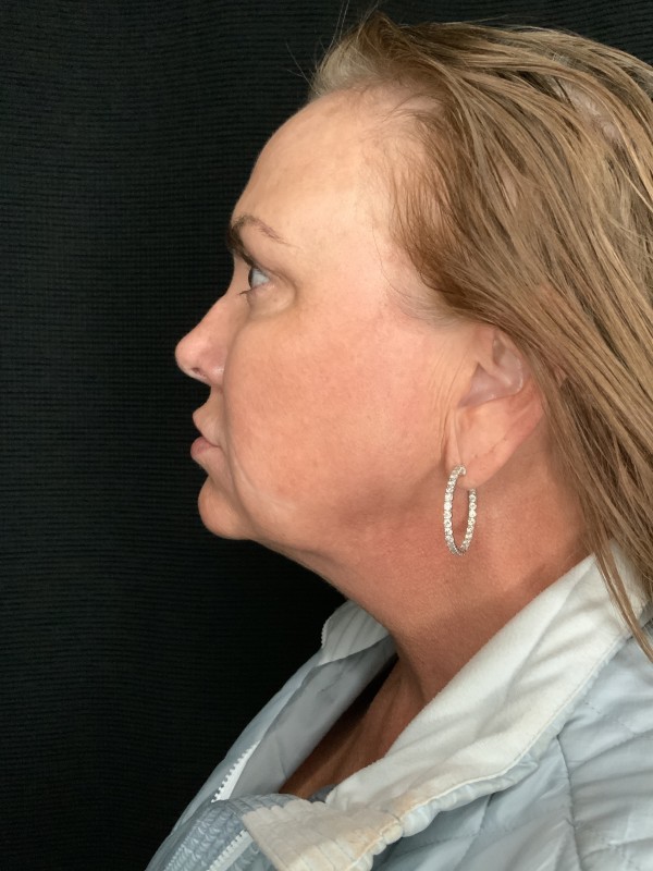 Patient #32148: FaceTite Before Image