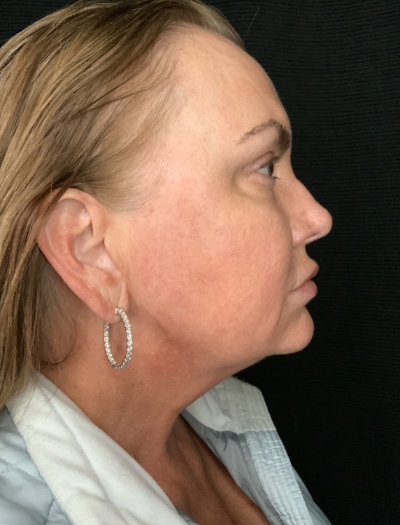 Patient #32148: FaceTite Before Image