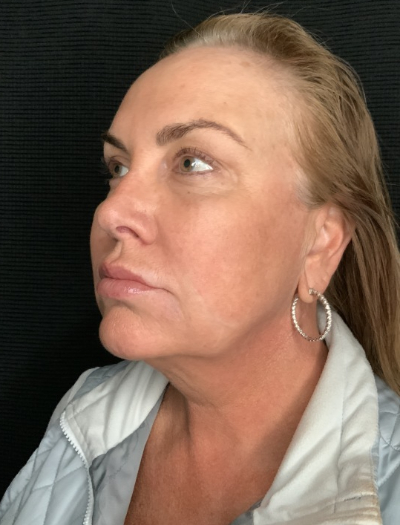 Patient #32148: FaceTite Before Image