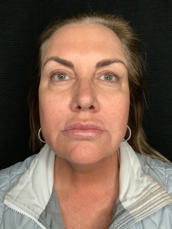 Patient #32148: FaceTite Before Image