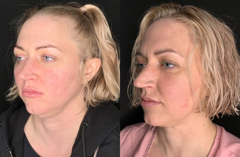 Patient #94325: FaceTite with Liposuction Combine Image