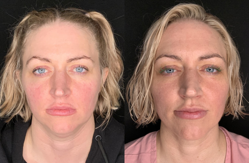 Patient #94325: FaceTite with Liposuction Combine Image