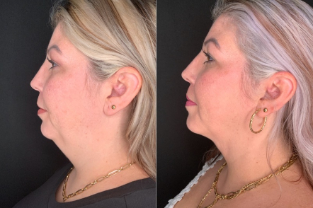 Patient #46523: FaceTite with Liposuction & Morpheus8 Combine Image