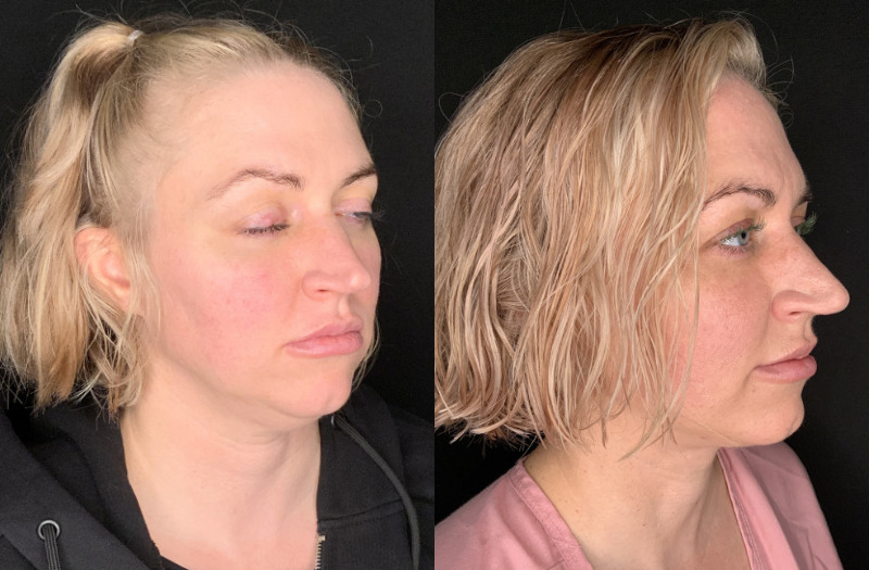Patient #94325: FaceTite with Liposuction Combine Image