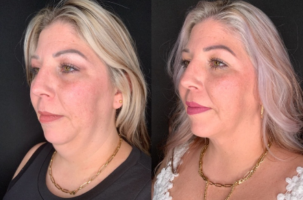 Patient #46523: FaceTite with Liposuction & Morpheus8 Combine Image
