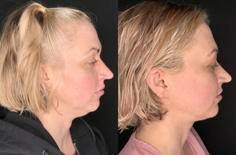 Patient #94325: FaceTite with Liposuction Combine Image
