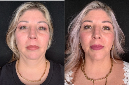 Patient #46523: FaceTite with Liposuction & Morpheus8 Combine Image