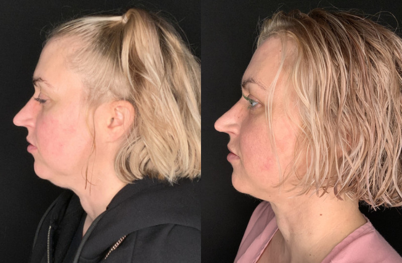 Patient #94325: FaceTite with Liposuction Combine Image