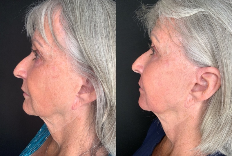 Patient #45320: Facial Fat Injections with Laser Resurfacing Combine Image