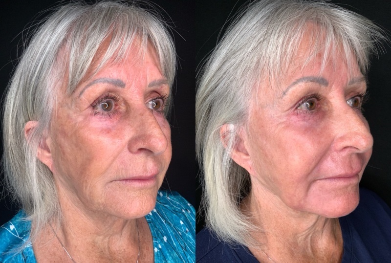 Patient #45320: Facial Fat Injections with Laser Resurfacing Combine Image