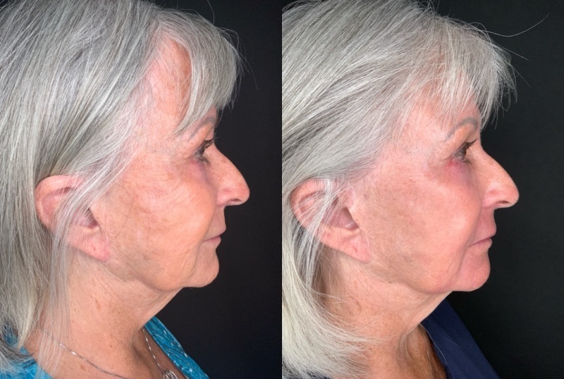 Patient #45320: Facial Fat Injections with Laser Resurfacing Combine Image