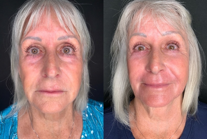 Patient #45320: Facial Fat Injections with Laser Resurfacing Combine Image