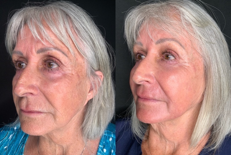 Patient #45320: Facial Fat Injections with Laser Resurfacing Combine Image