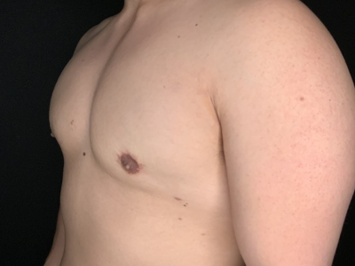 Patient #78965: Gynecomastia After Image