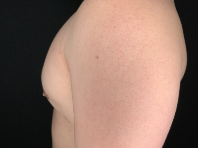 Patient #78965: Gynecomastia After Image