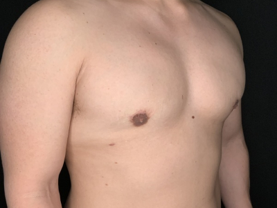 Patient #78965: Gynecomastia After Image