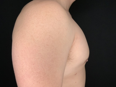 Patient #78965: Gynecomastia After Image