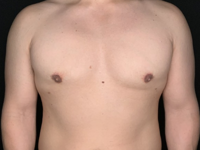 Patient #78965: Gynecomastia After Image