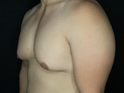 Patient #78965: Gynecomastia Before Image
