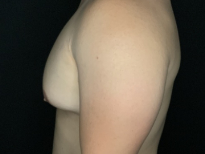Patient #78965: Gynecomastia Before Image