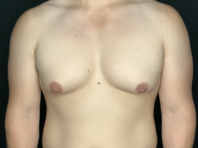 Patient #78965: Gynecomastia Before Image