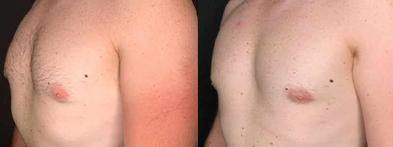 Patient #41258: Gynecomastia with Liposuction Combine Image