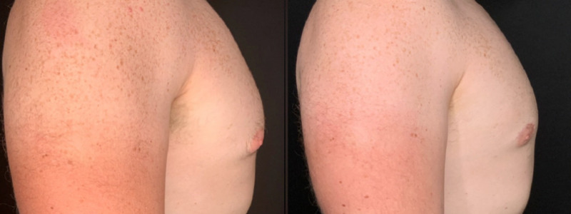 Patient #41258: Gynecomastia with Liposuction Combine Image
