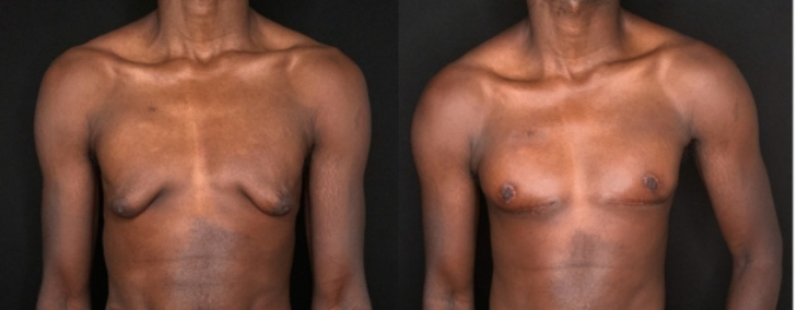 Patient #32587: Gynecomastia Combine Image