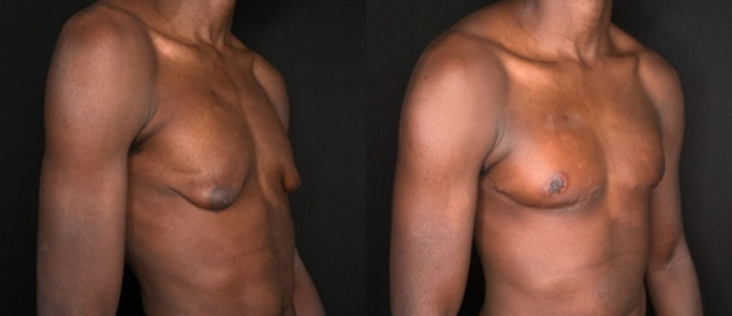 Patient #32587: Gynecomastia Combine Image