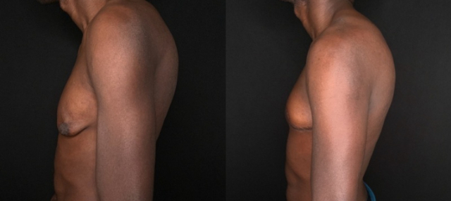 Patient #32587: Gynecomastia Combine Image