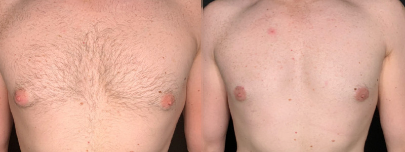Patient #41258: Gynecomastia with Liposuction Combine Image