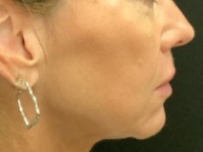 Patient #14598: Volbella After Image