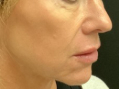 Patient #14598: Volbella After Image